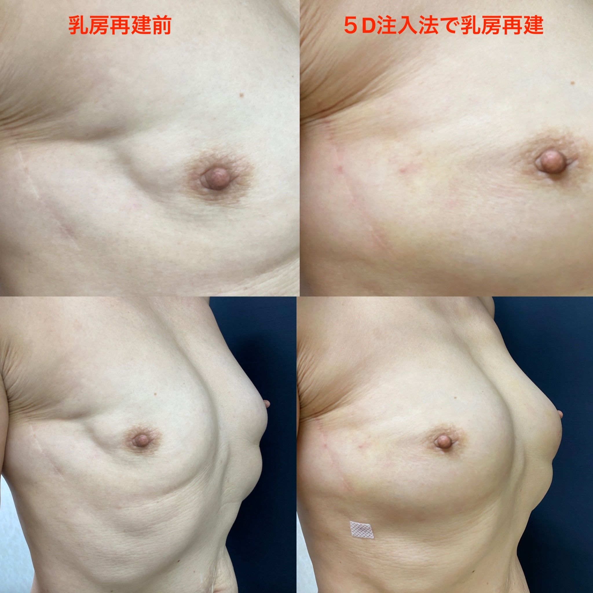 乳房再建　１M比較のコピー