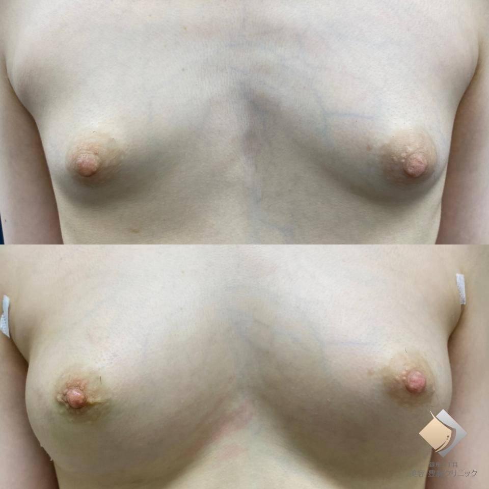 上：手術前　下：手術後１ヶ月