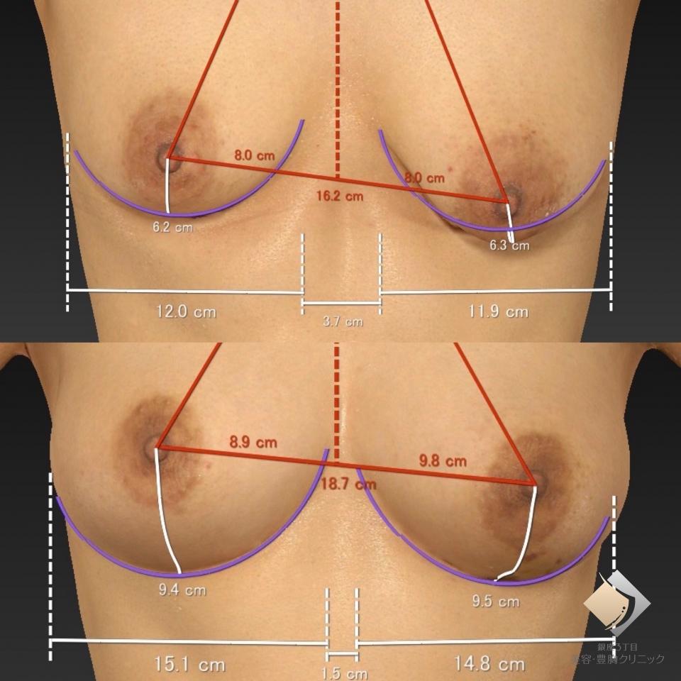 手術前後の乳房サイズ変化