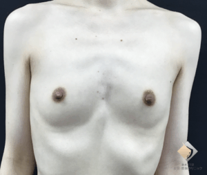 ＜痩せ型(BMI17.6)－バストの高さを出せれば骨っぽさを解消できる－＞（施術前）
