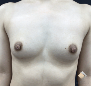 ＜バストの形を整える－BANNAI式オリジナル３D注入法なら下乳のサイズアップが可能－＞（施術前）