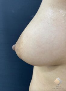 ＜垂れ乳(乳房下垂)改善－BANNAI式オリジナル３D注入法で上向きに－＞（施術後）