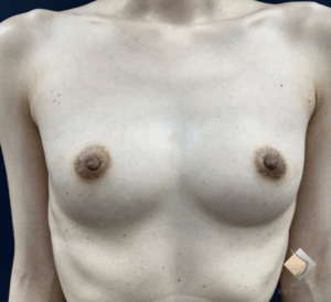 ＜バストを大きくしたい！＞　30代　授乳歴なし　５D注入法 誕生のきっかけとなった定着率79％のケース！（施術前）
