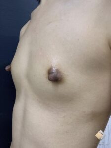 ＜バストを大きくしたい　ので５回しちゃった＞　20代　授乳歴なし　（1回はサイズ保証で麻酔代のみ＆リピート割併用）（施術前）