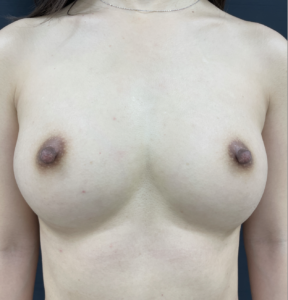 ＜バストを大きくしたい　ので５回しちゃった＞　20代　授乳歴なし　（1回はサイズ保証で麻酔代のみ＆リピート割併用）