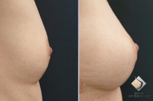 バストの若返り（全体のボリュームダウン、下垂、乳輪のしわ）（施術後）
