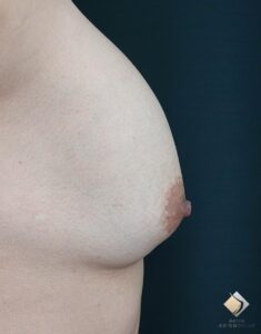 他院シリコンバック取り出し＆同時アキ―セル併用コンデンスリッチ豊胸をBANNAI式オリジナル３D注入法で修正（施術前）
