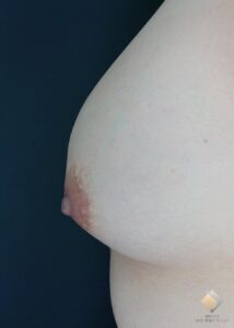 他院シリコンバック取り出し＆同時アキ―セル併用コンデンスリッチ豊胸をBANNAI式オリジナル３D注入法で修正（施術前）