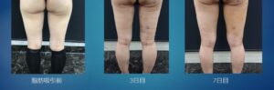 脂肪豊胸手術後の内出血について（脂肪吸引部・大腿編）