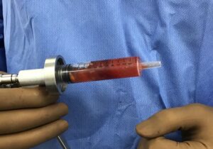 ヒアルロン酸豊胸について⑤　完全に溶けるし、溶かせる？