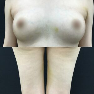 今日の内出血⑦