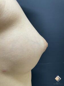 最難度！乳房低形成のバストを本物のようにする！　BANNAI式オリジナル３D注入法以外は不可能かな〜！ AAカップ①（施術後）