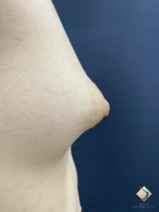 最難度！乳房低形成のバストを本物のようにする！　BANNAI式オリジナル３D注入法以外は不可能かな〜！ AAカップ①（施術前）