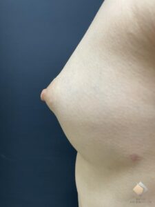 最難度！乳房低形成のバストを本物のようにする！　←BANNAI式オリジナル３D注入法以外では、不可能かな〜！AAカップ①（施術後）