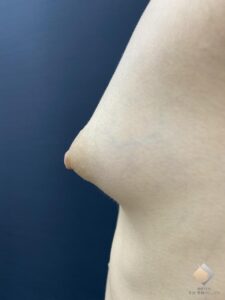 最難度！乳房低形成のバストを本物のようにする！　←BANNAI式オリジナル３D注入法以外では、不可能かな〜！AAカップ①（施術前）