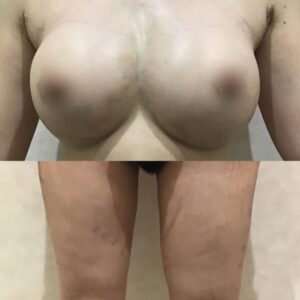 今日の内出血２２