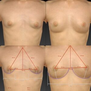 BANNAI式オリジナル３D注入法の真骨頂②　乳房低形成の人のバストを本物みたく仕上げる！