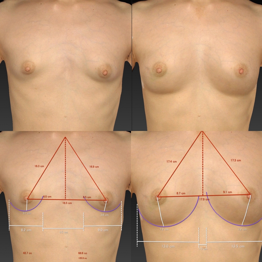 BANNAI式オリジナル３D注入法の真骨頂②　乳房低形成の人のバストを本物みたく仕上げる！
