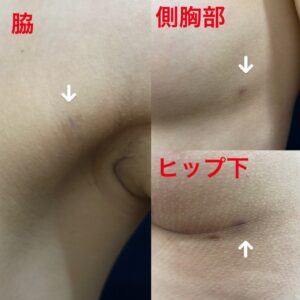脂肪豊胸の傷（３ヶ月目）