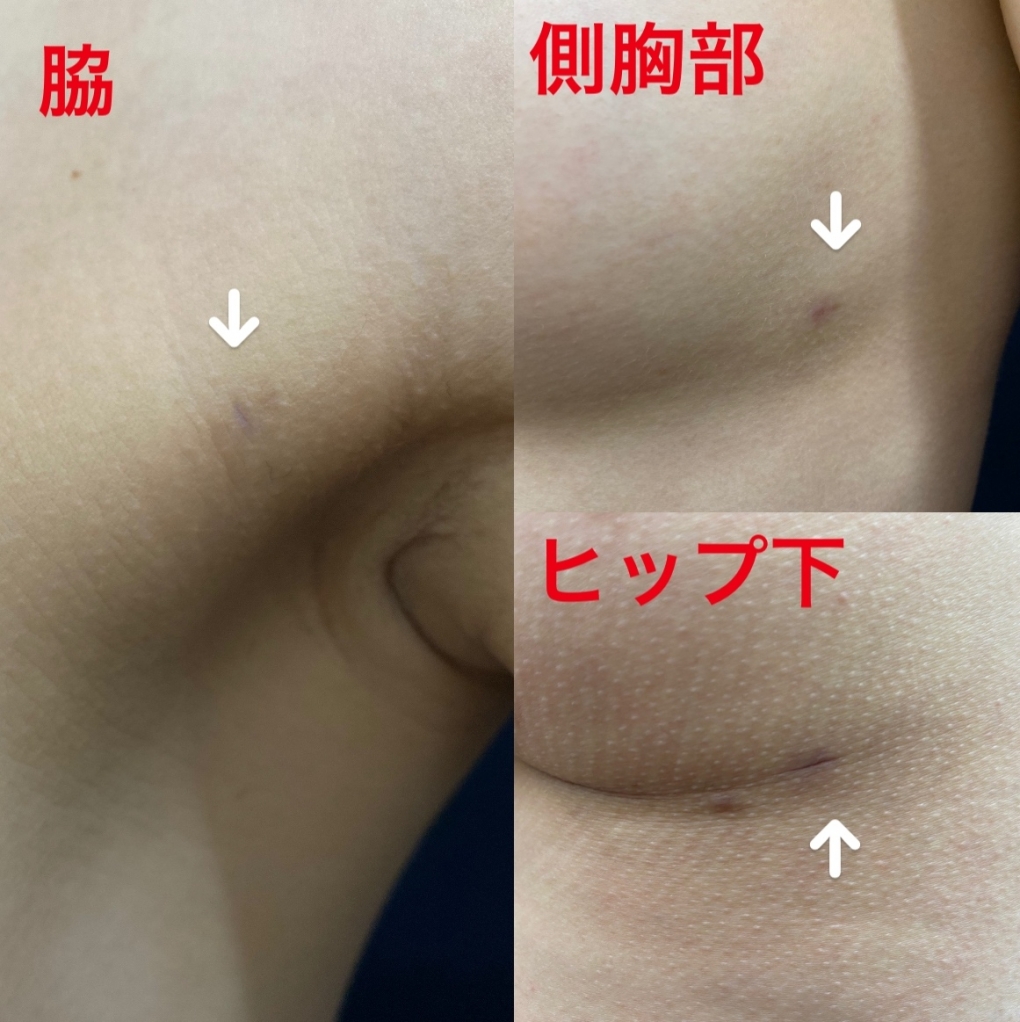 脂肪豊胸の傷（３ヶ月目）