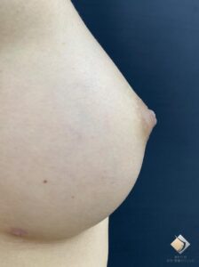 大きくしたい③　（２回脂肪豊胸手術したケース）（施術後）