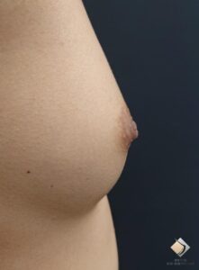 大きくしたい③　（２回脂肪豊胸手術したケース）（施術前）