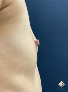 AAカップ③ ＆ 左右差解消②（20代）（施術前）