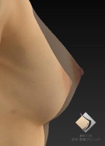もっと大きく綺麗に！　元々Dカップ→Eカップ超え！（施術後）