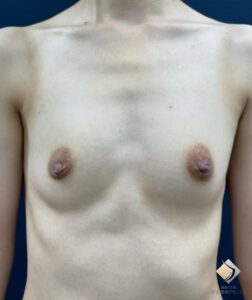 AAカップ④ ＆ 左右差解消③ ＆ 側弯 （20代）（施術前）