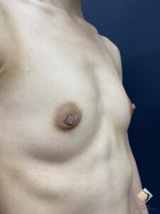 AAカップ④ ＆ 左右差解消③ ＆ 側弯 （20代）（施術前）