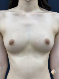 AAカップ⑤（20代）１回の脂肪豊胸でAAカップ→上品なBカップに！（施術後）