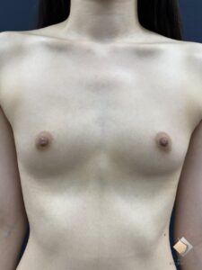 AAカップ⑤（20代）１回の脂肪豊胸でAAカップ→上品なBカップに！（施術前）