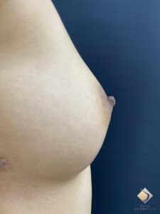 AAカップ⑥（30代）（施術後）