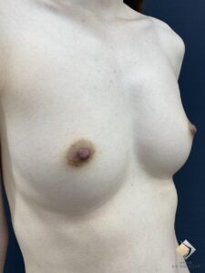 アキーセル併用コンデンスリッチ豊胸をBANNAI式オリジナル３D注入法で！（施術前）