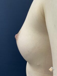 アキーセル併用コンデンスリッチ豊胸をBANNAI式オリジナル３D注入法で！（施術前）