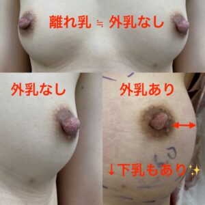 離れ乳の治し方＝外乳の効果