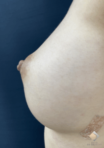 ＜脂肪豊胸手術2回－3D注入法でより立体的に、そして美巨乳に－＞（施術後）