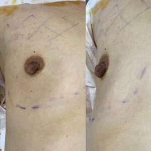 シリコンバックで豊胸をしたら、サイズも一生ものか？　シリコンバック豊胸　その後を考える②