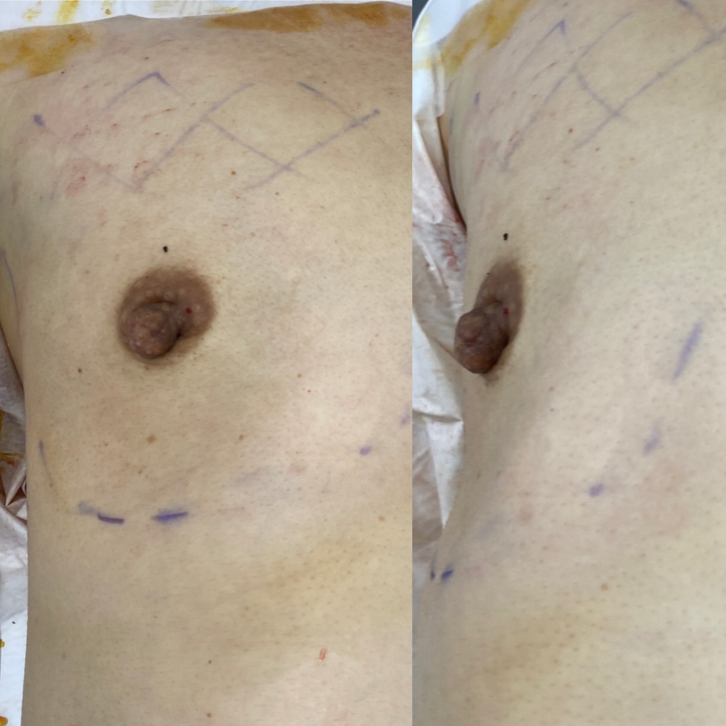 シリコンバックで豊胸をしたら、サイズも一生ものか？　シリコンバック豊胸　その後を考える②