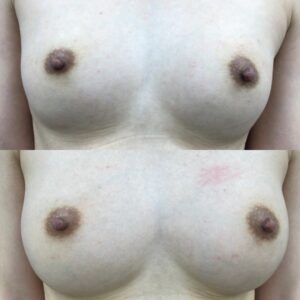 自然な豊胸と言えば、やっぱり脂肪豊胸が一番！