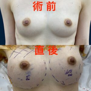 痩せ型の脂肪豊胸のコツ！　脂肪注入量　左右合計 280cc でこの仕上がり！