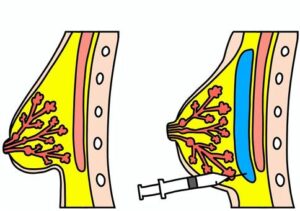 脂肪豊胸後の腫れが引かない|いつまで続く?対処法は?