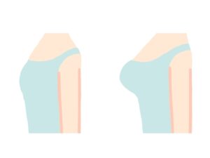 ダイエット後に脂肪豊胸を受けるベストタイミングは?