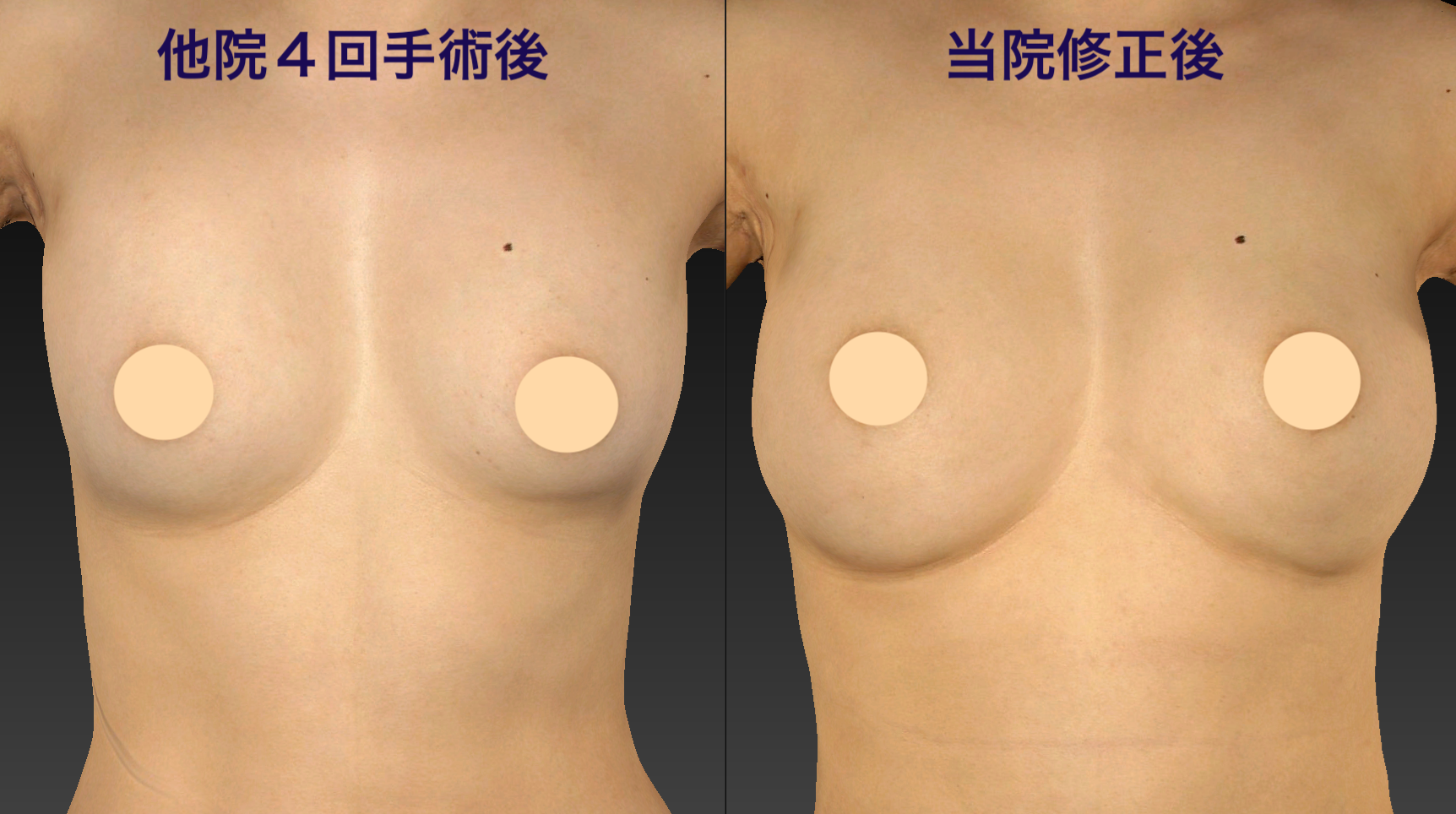症例：他院で4回手術後の下乳の形と当院での修正例（術前 → 術後、加工なし）