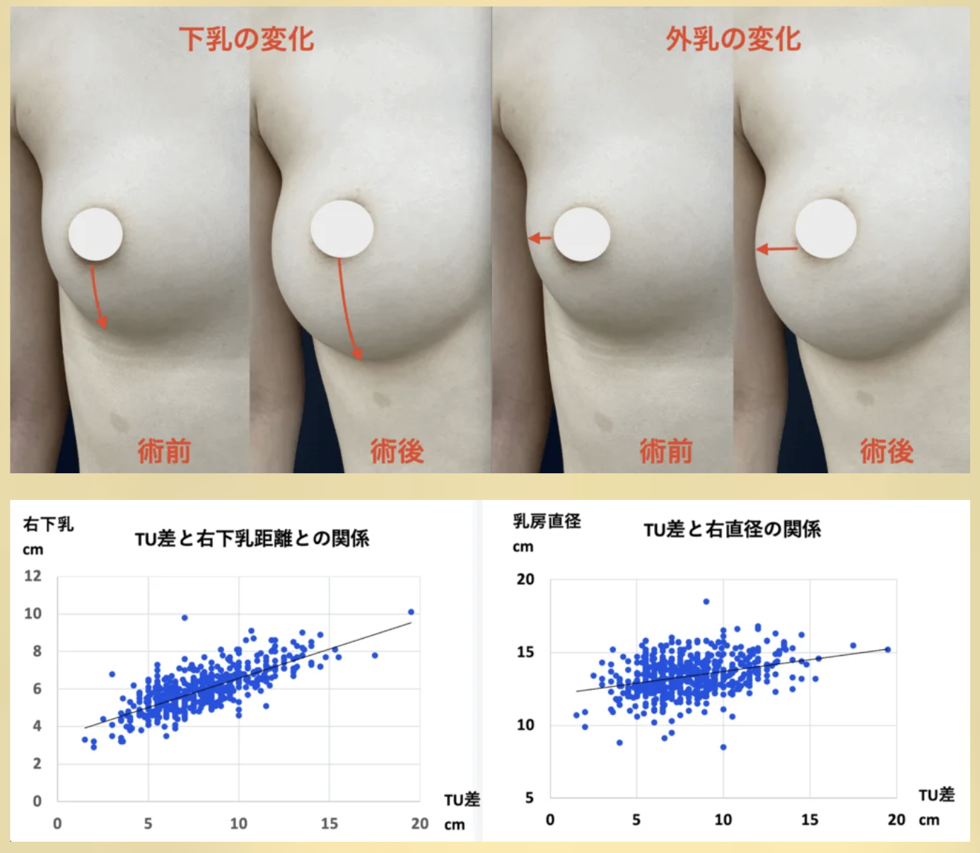 症例：脂肪豊胸術前後（左：下乳の変化 術前/術後、右：外乳の変化 術前/術後、赤矢印は変化方向、加工あり）と TU差・下乳距離・乳房直径の散布図（院内594例解析）
