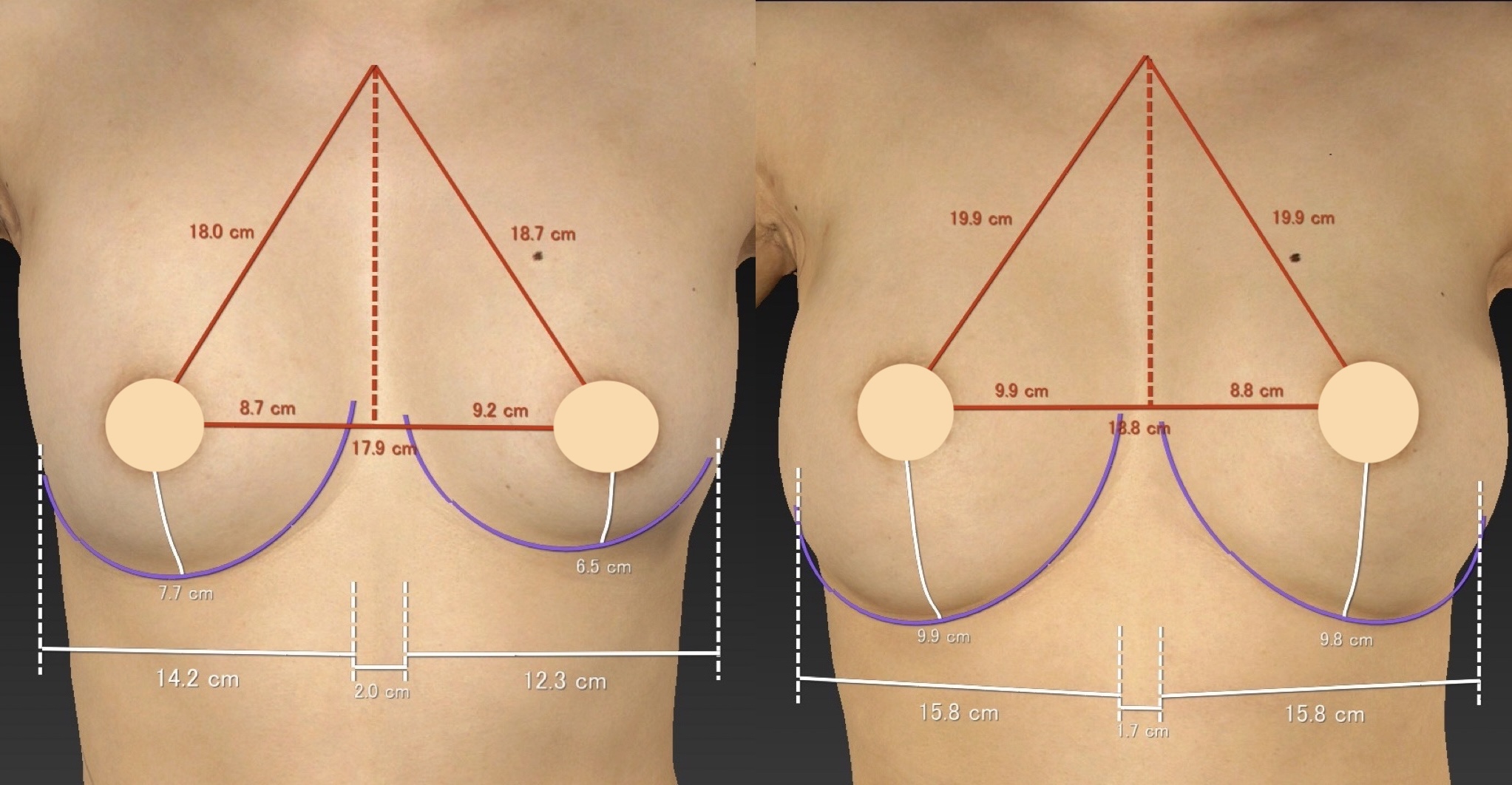 同一症例の正面比較。下乳の表面距離と乳房幅の計測線。左：当院修正前、右：2026年5月11日